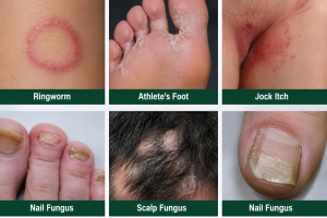types of Skin Fungus