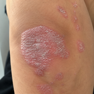 Psoriasis