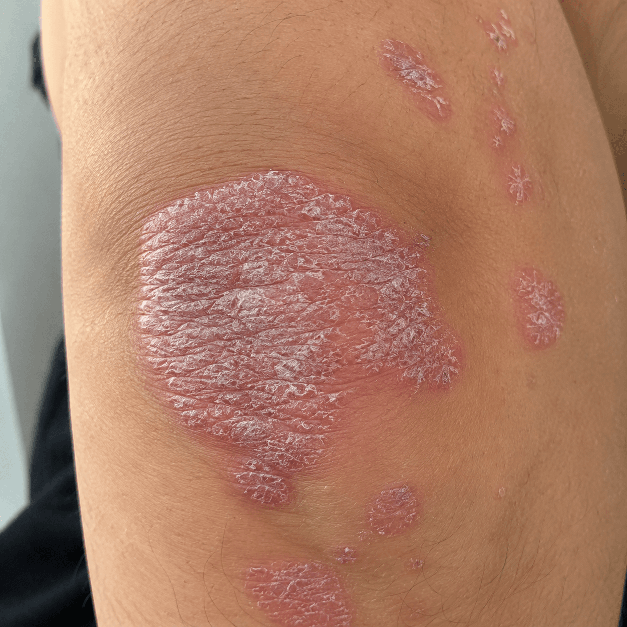 Psoriasis plaque with silvery scales on elbow skin