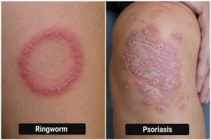 Ringworm vs Psoriasis