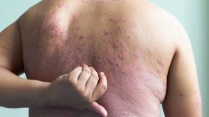 Plaque Psoriasis