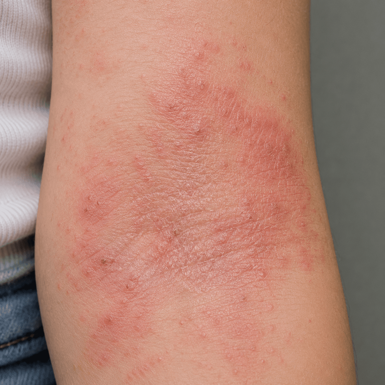 Red itchy eczema skin condition patch on inner elbow flexure