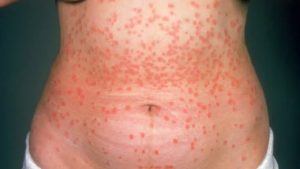 Guttate Psoriasis