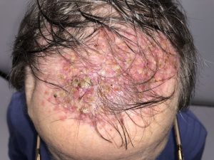 Tinea Capitis
