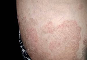 Tinea Cruris