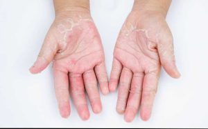 Tinea Manuum