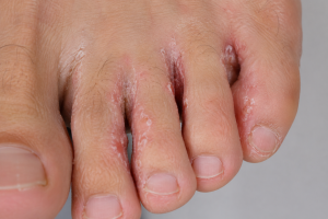 what is Athlete's Foot