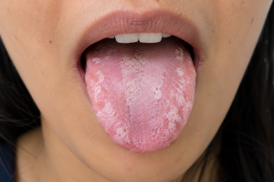 what is candida