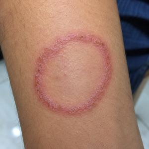 Ringworm