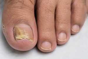 what is nail fungs