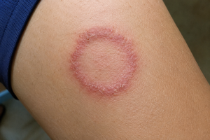 lebrostone cream for ringworm