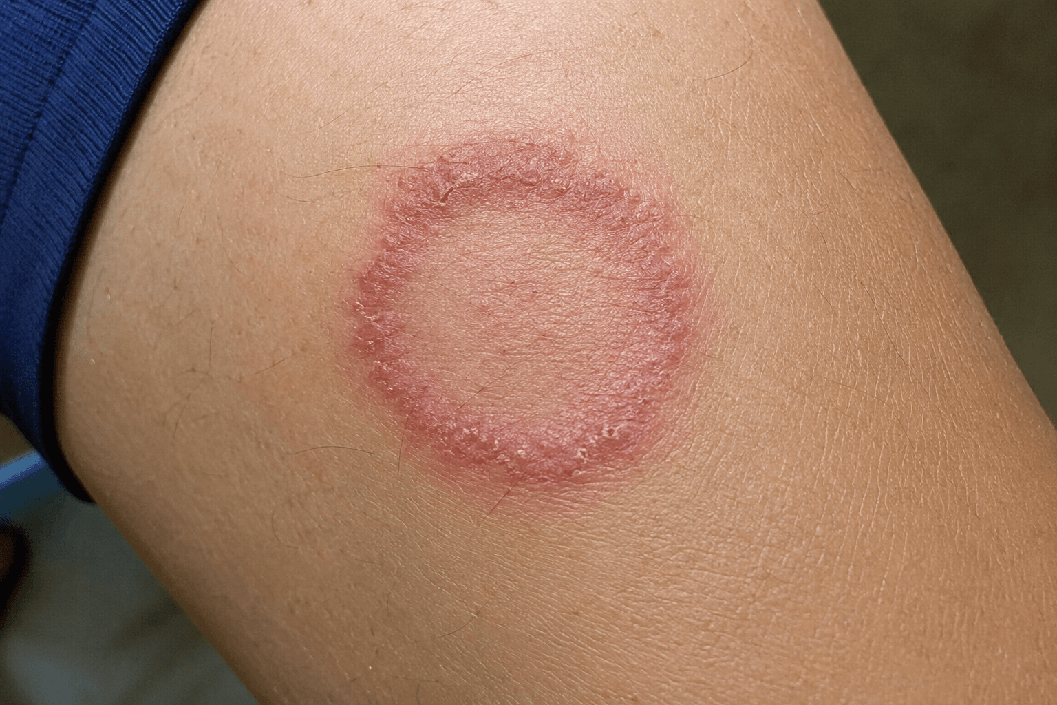 Red circular ringworm fungal infection rash on skin