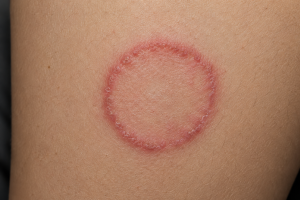 what is ringworm