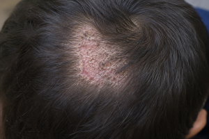 what is scalp fungs