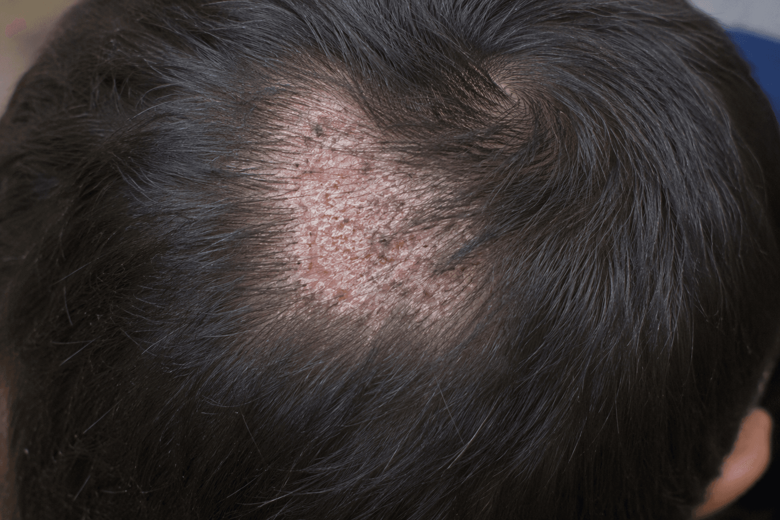 Scalp fungus tinea capitis with hair loss patch