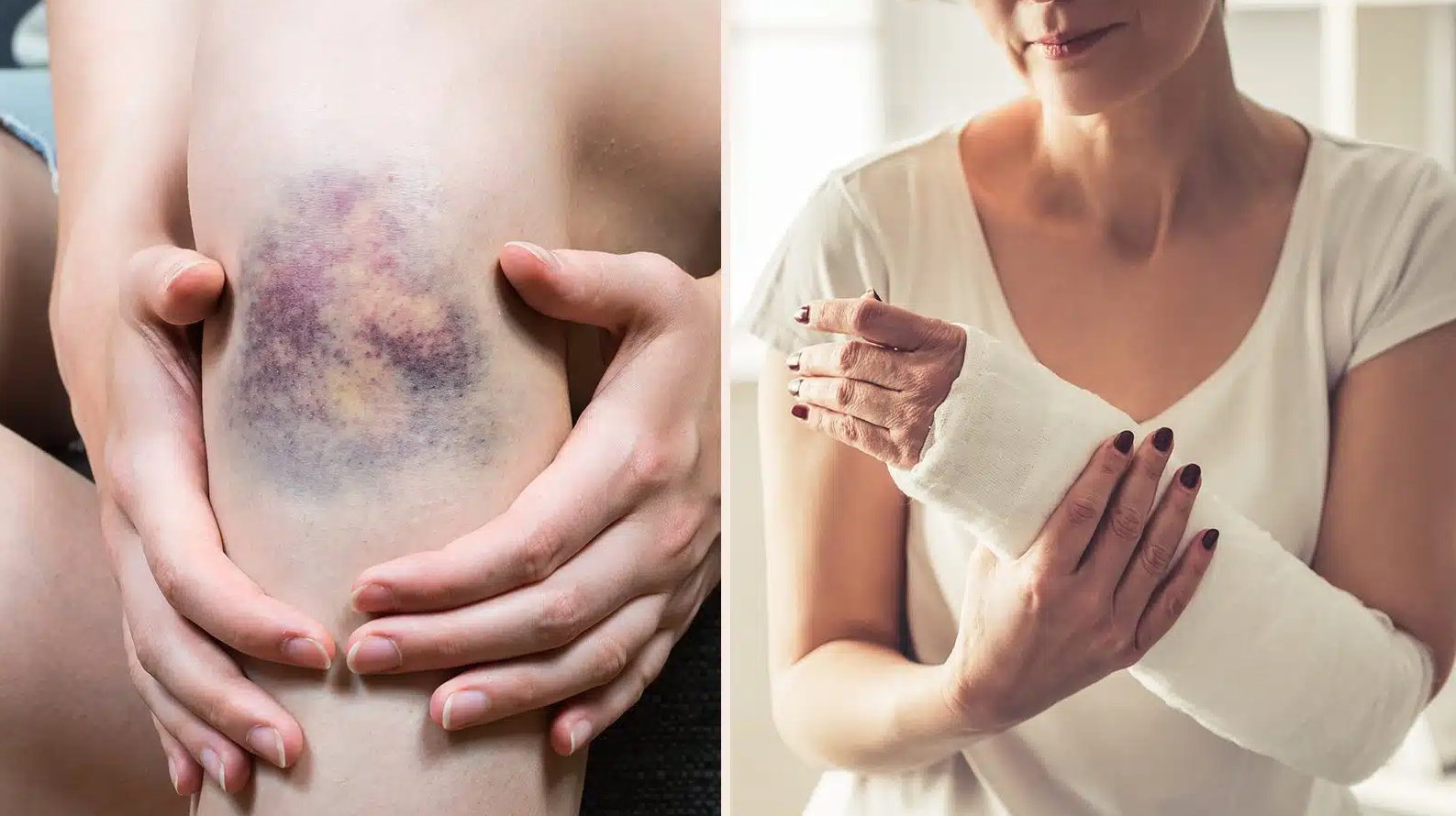 Symptoms of Vitamin K1 Deficiency