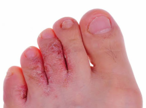 tinea pedis