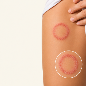 Tinea Corporis: