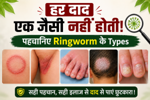 Ringworm के Types