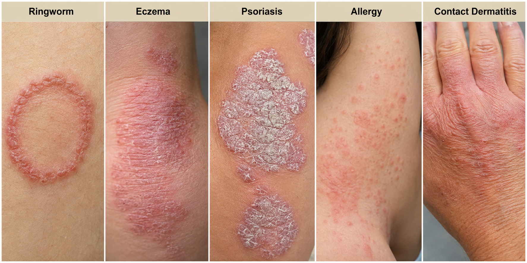 Types of Ringworm - Fungal Skin Infection Types