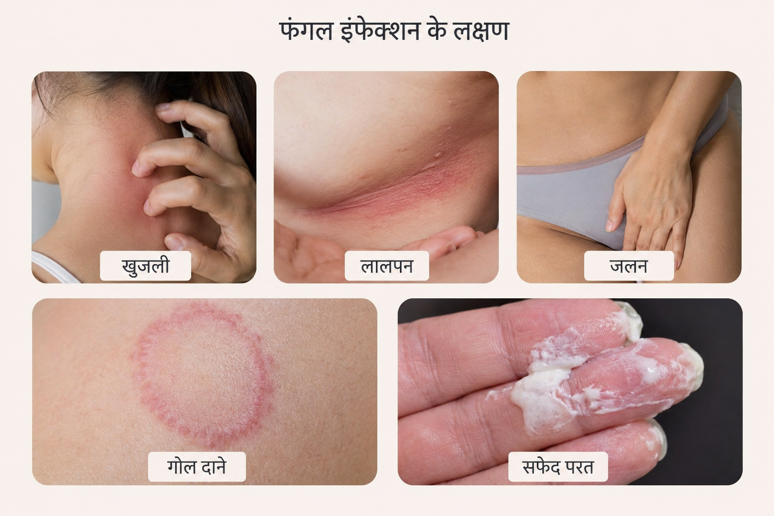 महिलाओं में फंगल इंफेक्शन