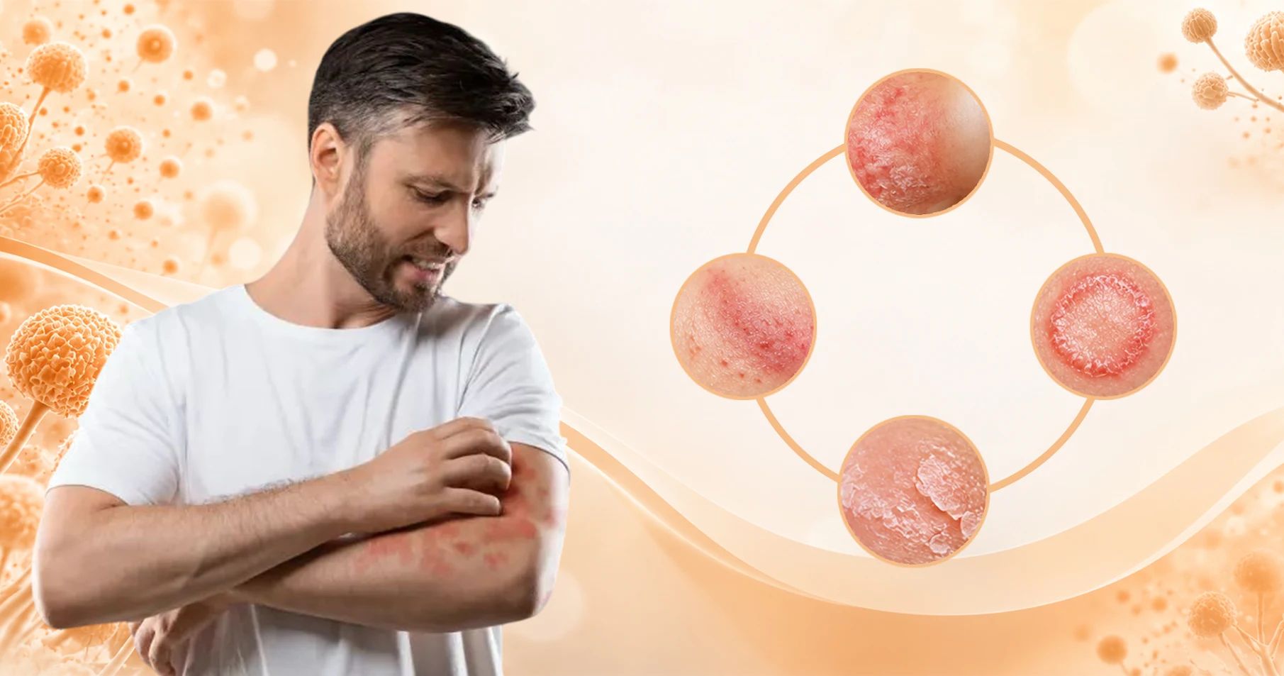 Common Signs of Fungal Skin Infection
